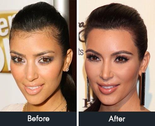 The Controversy Surrounding Kim Kardashian's Hairline: A Closer Look