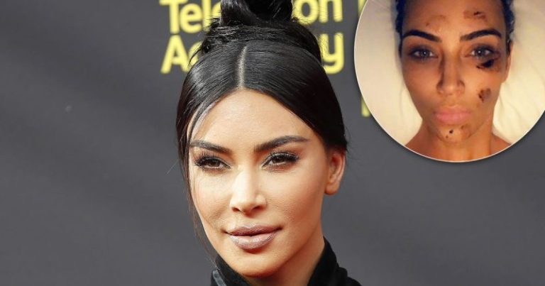 The Impact of Kim Kardashian’s Vegan Diet on Psoriasis 