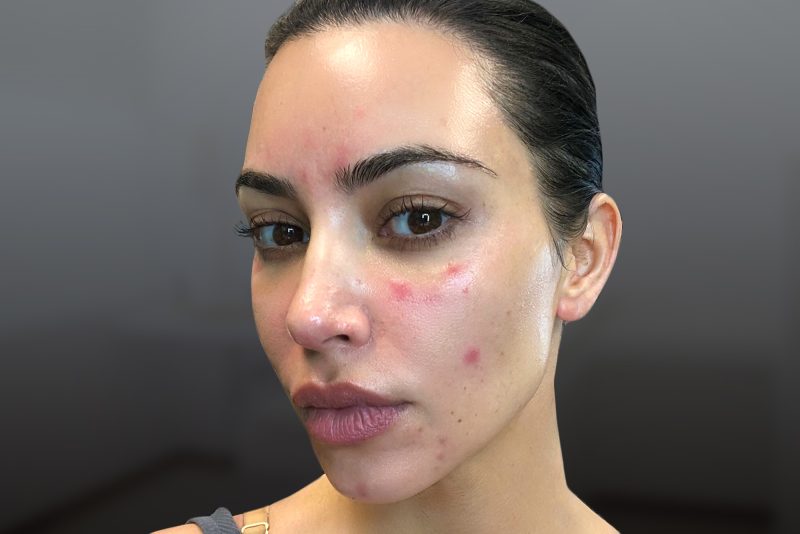 The Unveiling of Kim Kardashian's Battle with Psoriasis