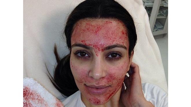 The Controversial Kim Kardashian Blood Facial: A Bizarre Beauty Trend or Just Hype? 